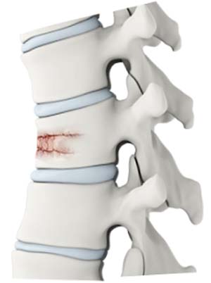 https://www.londonspinecare.co.uk/3d-images/vertebral-fracture.jpg
